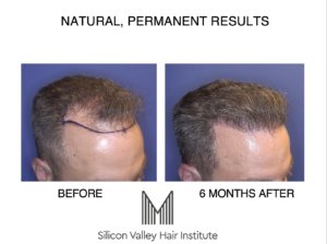 An affordable San Jose hair transplant is in Foster City