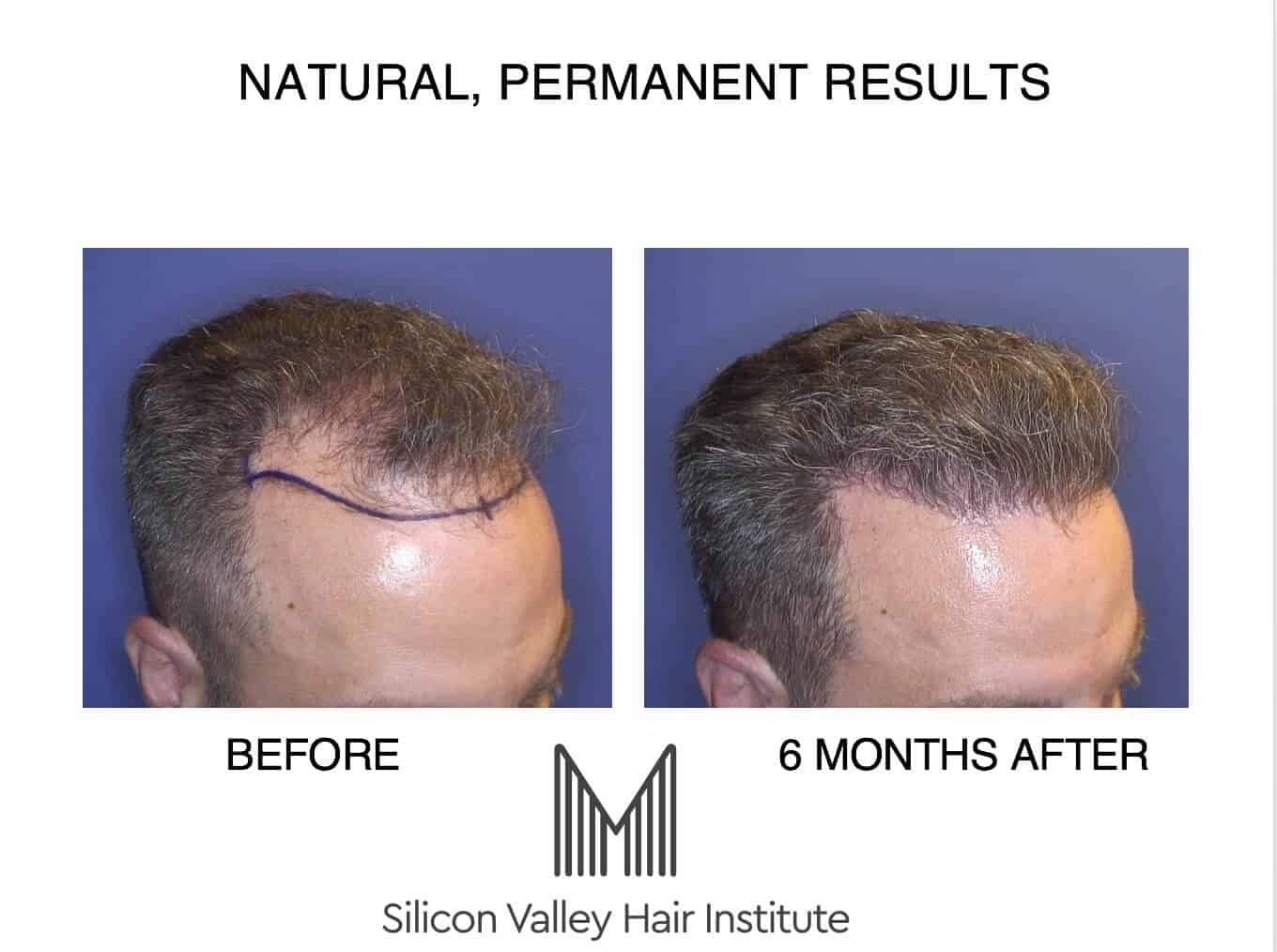 How Much Is A Hair Transplant In The Philippines