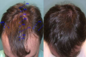  Hair transplant costs can vary by city even in the Bay Area.