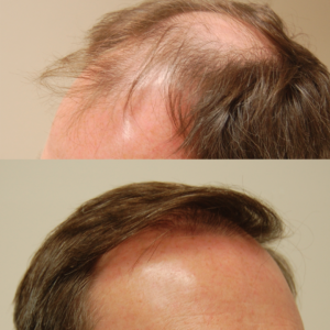  A hair transplant specialist in the Bay Area.