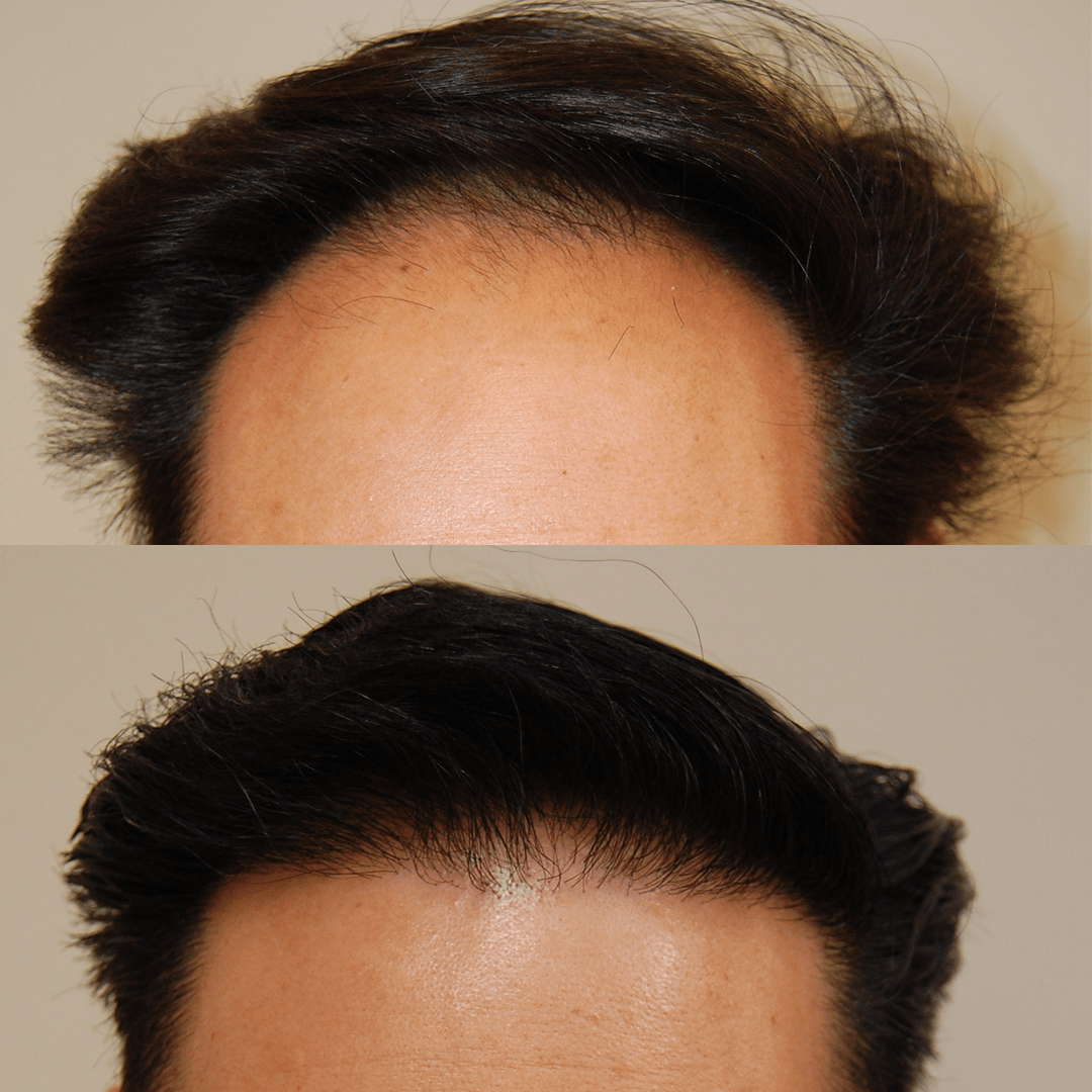 Only One San Francisco Bay Area Hair Transplant Review Matters Yours