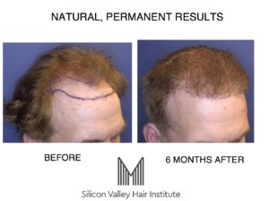 Menlo Park hair transplantation.