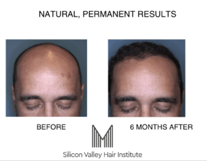 A robot can help with a hair transplant via the ARTAS procedure