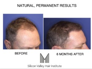 For ARTAS hair transplants you need Silicon Valley Hair Institute.
