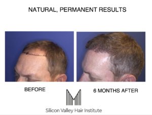 A specialist doctor is required for a Bay Area hair transplant.