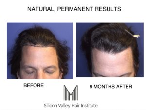  Bay Area hair transplant reviews of before and after photos