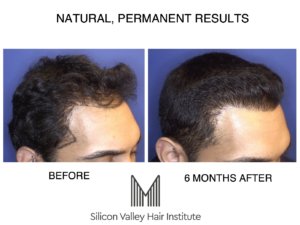 If you want a robotic hair transplant, come to Foster City.