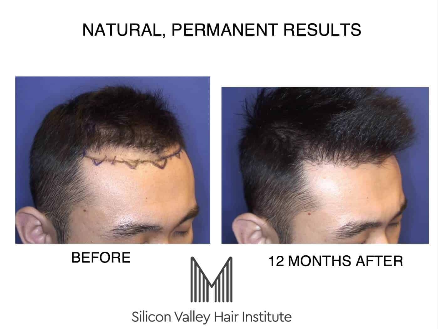 San Mateo Juvederm