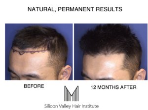 Silicon Valley Institute, the Bay Area ARTAS Hair Transplant Experts,  Announces New Post on Robotic Hair Transplantation Options