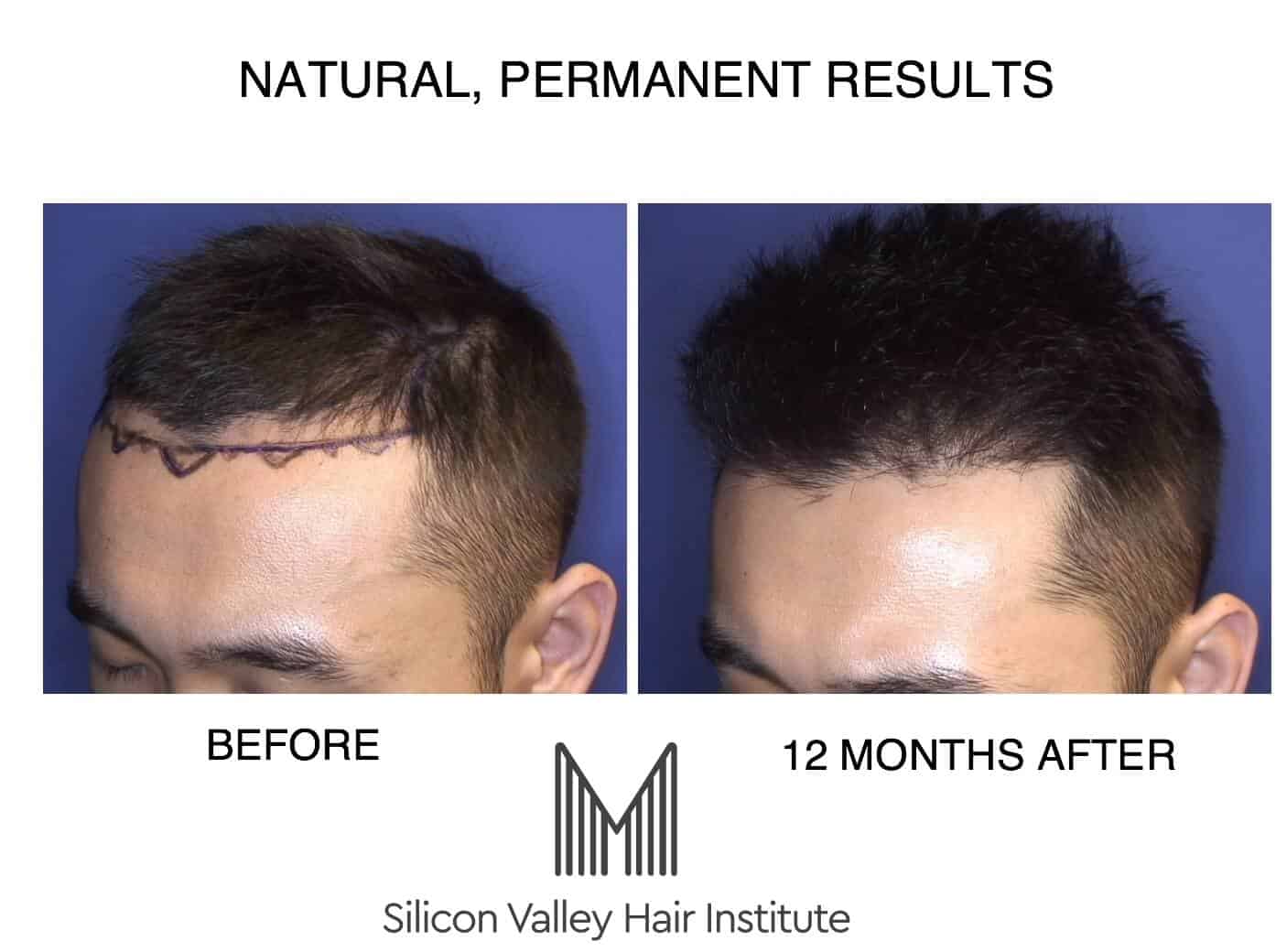 hair restoration Bay Area
