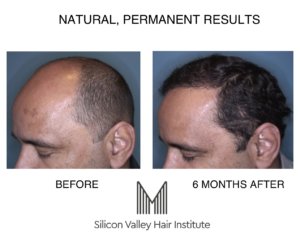 Hair transplant success rates can vary with the individual.