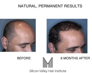 Micropigmentation can help to disguise baldness.