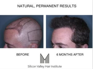 Palo Alto hair transplant specialist.
