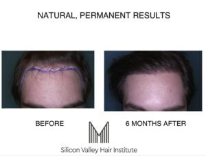 Hair transplant cost is not the major consideration