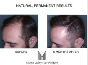 Cost of hair transplant in Bay Area