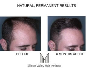 You Might Not Believe It, but You Can Get a Robotic Hair Transplant in the  Bay Area