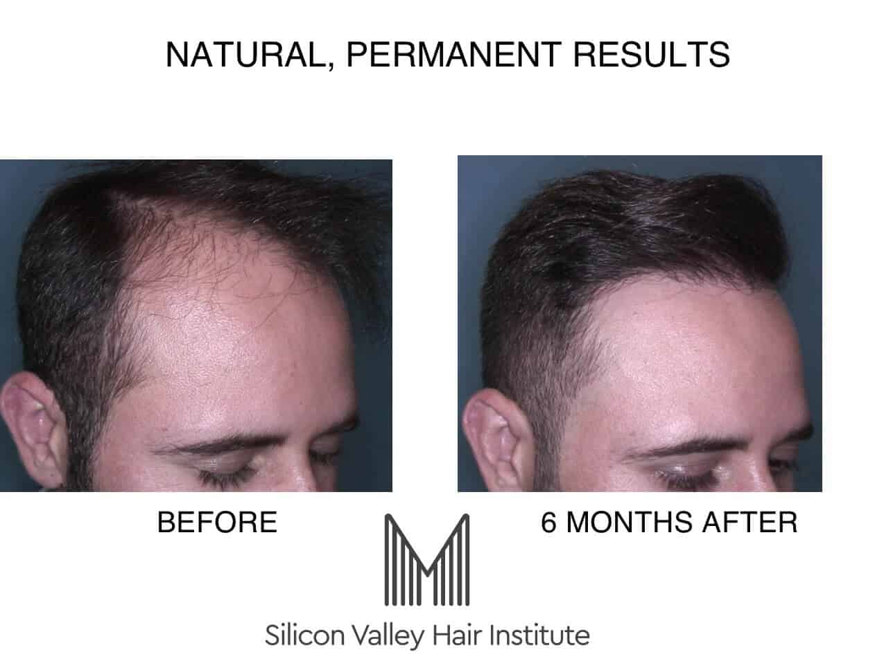Silicon Valley Hair Institute is in Foster City.