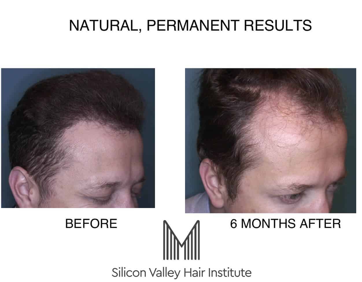 FUE transplant, ARTAS transplant