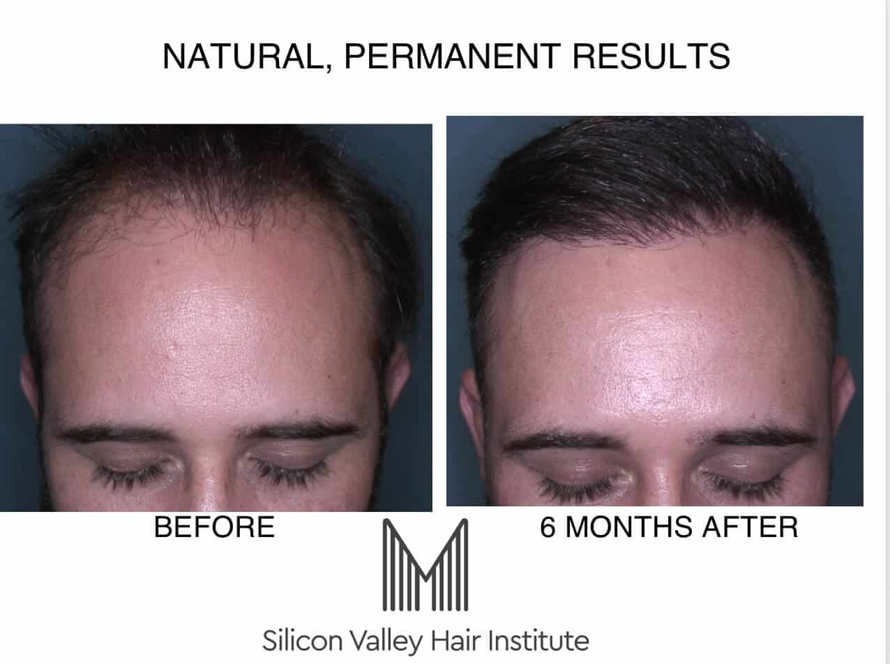 FUE transplant California