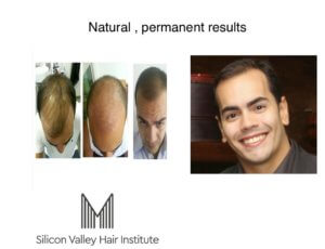 You need an expert opinion on the cost of hair grafts in San Mateo.