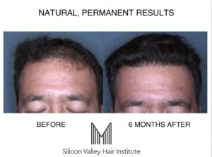 cost of a hair transplant Bay Area