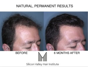 Free Zoom or Facebook hair transplant consultations online and in the Bay Area