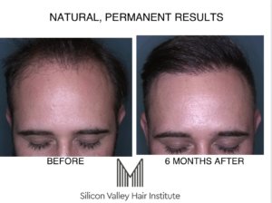 cost of a hair transplant Bay Area