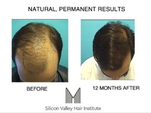 robotic hair transplant in the Bay Area