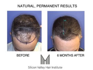 The Best Hair Transplant in San Francisco Remains Outside of San Francisco