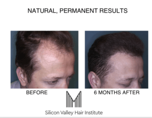 You need to see an expert for a hair transplant.