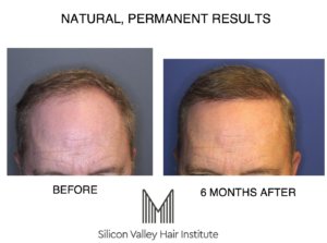 Best hair transplant doctors in Turkey – The Upcoming