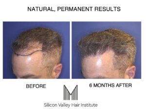 For a San Mateo hair transplant, zip over to Foster City.