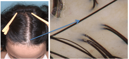 Women's Hair Transplant (Female Hair Loss Restoration) - San Francisco Bay  Area, Palo Alto, Menlo Park - Silicon Valley Hair Institute