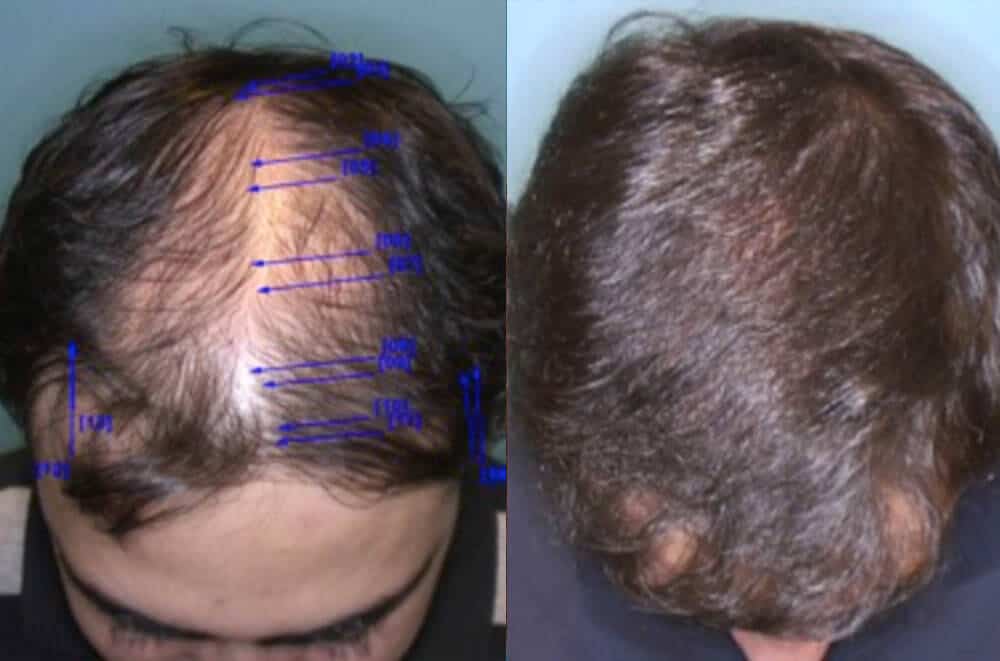 Beverly Hills Hair Transplant