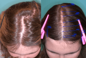  Bay Area Hair Transplants for Women