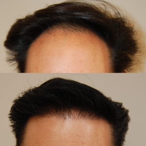 Only One San Francisco Bay Area Hair Transplant Review Matters: Yours