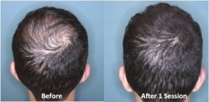 Difference: Exclusive Hair Transplant clinics vs Complete cosmetic care  clinics