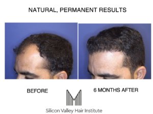 Foster City is the place for Redwood City hair transplants.