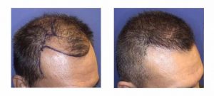 Hair loss treatment options at Silicon Valley Hair Institute
