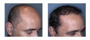 cost of a hair transplant in the Bay Area