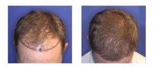 A robotic hair transplant right on your doorstep