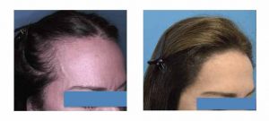 An eyebrow transplant can totally transform your looks.