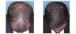 Silicon Valley Hair Institute can help with hair loss