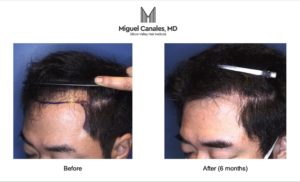 Bay Area hair transplantation offers before and after photos of male and female hair loss.