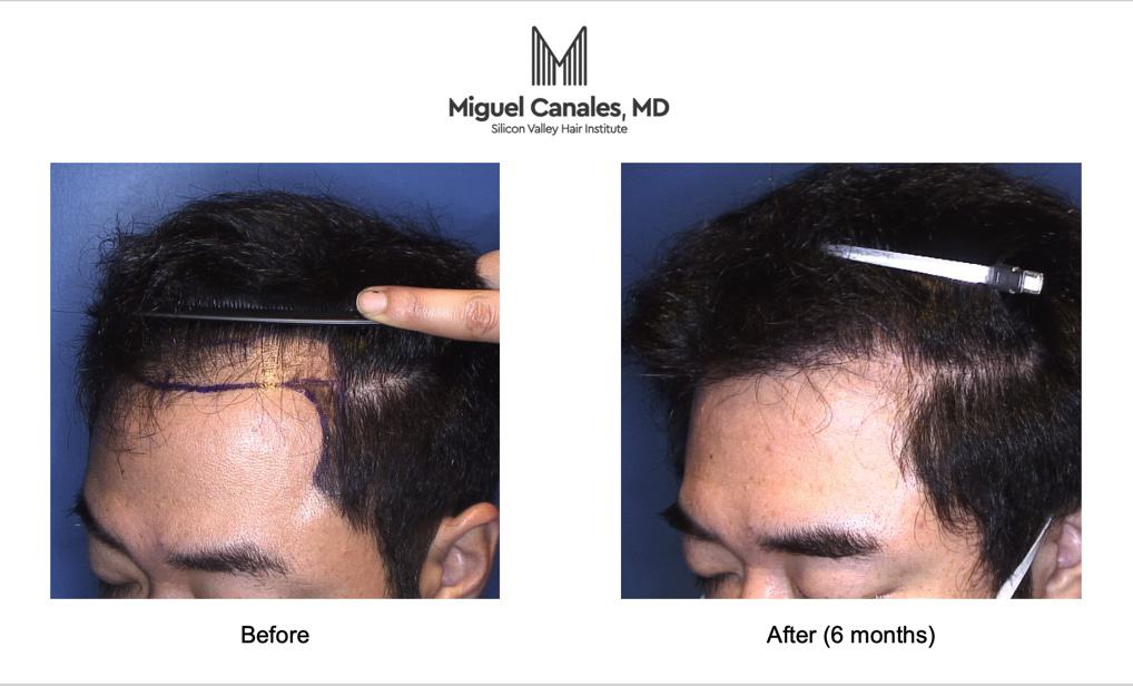 Silicon Valley Institute Announces Update to Bay Area Hair Transplantation  