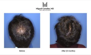 hair transplant in Foster City, CA