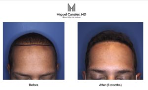  Finding the best hair transplant specialist 