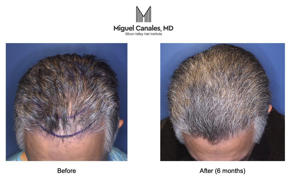 Recovery Timeline of Hair Growth after NeoGraft  Nashville Hair Doctor