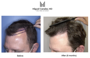 A robotic hair transplant is available in Foster City