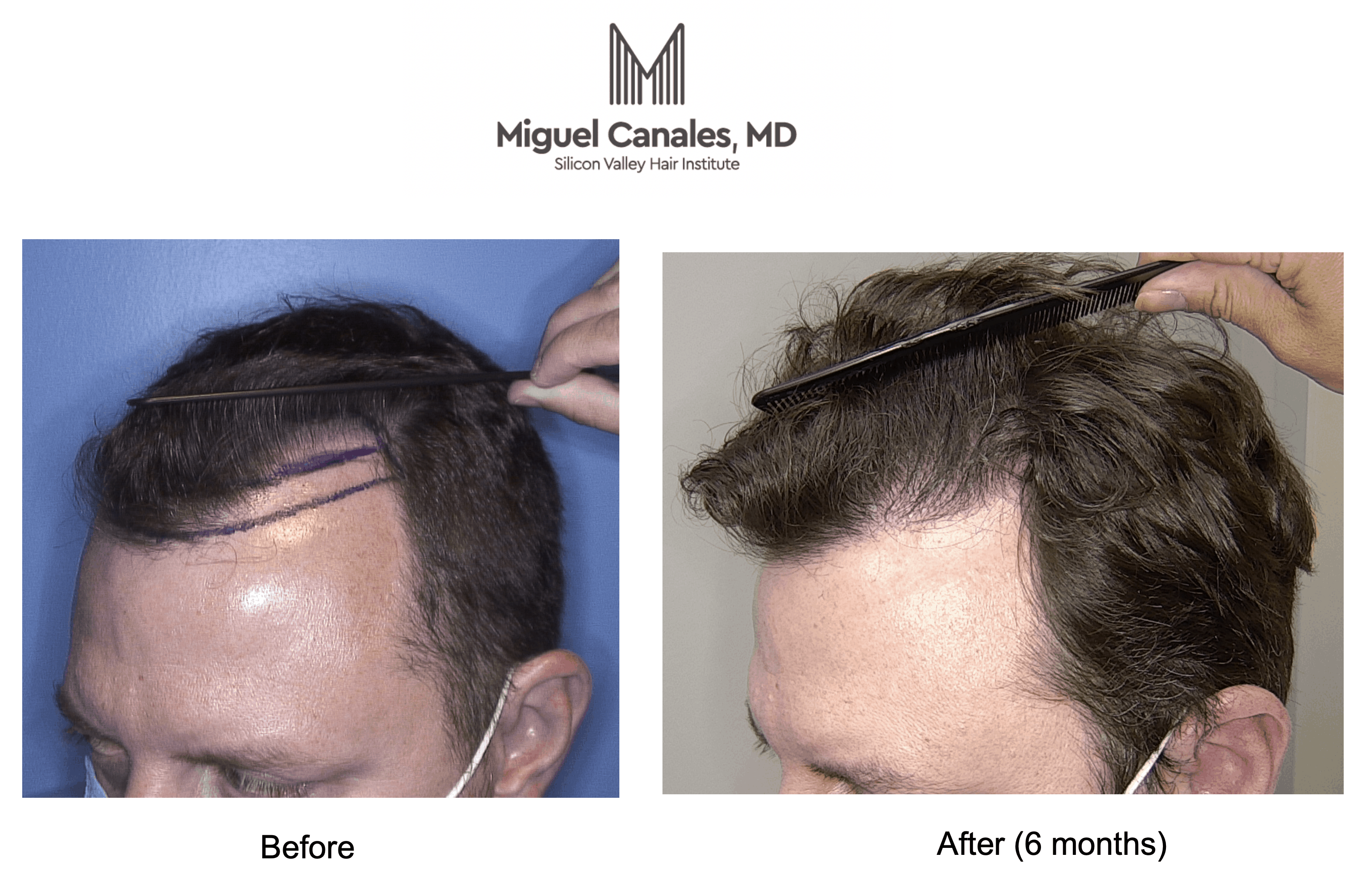 The World's Leading Expert Restores Your Hair Loss With a Robot - Miguel  Canales .